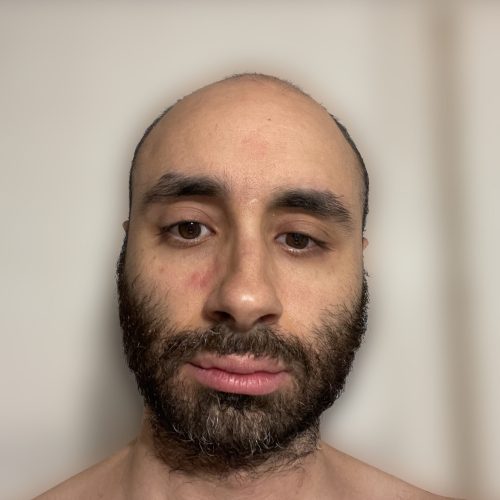 Psoriasis on Face